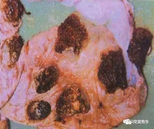 子宮炎癥臨床癥狀